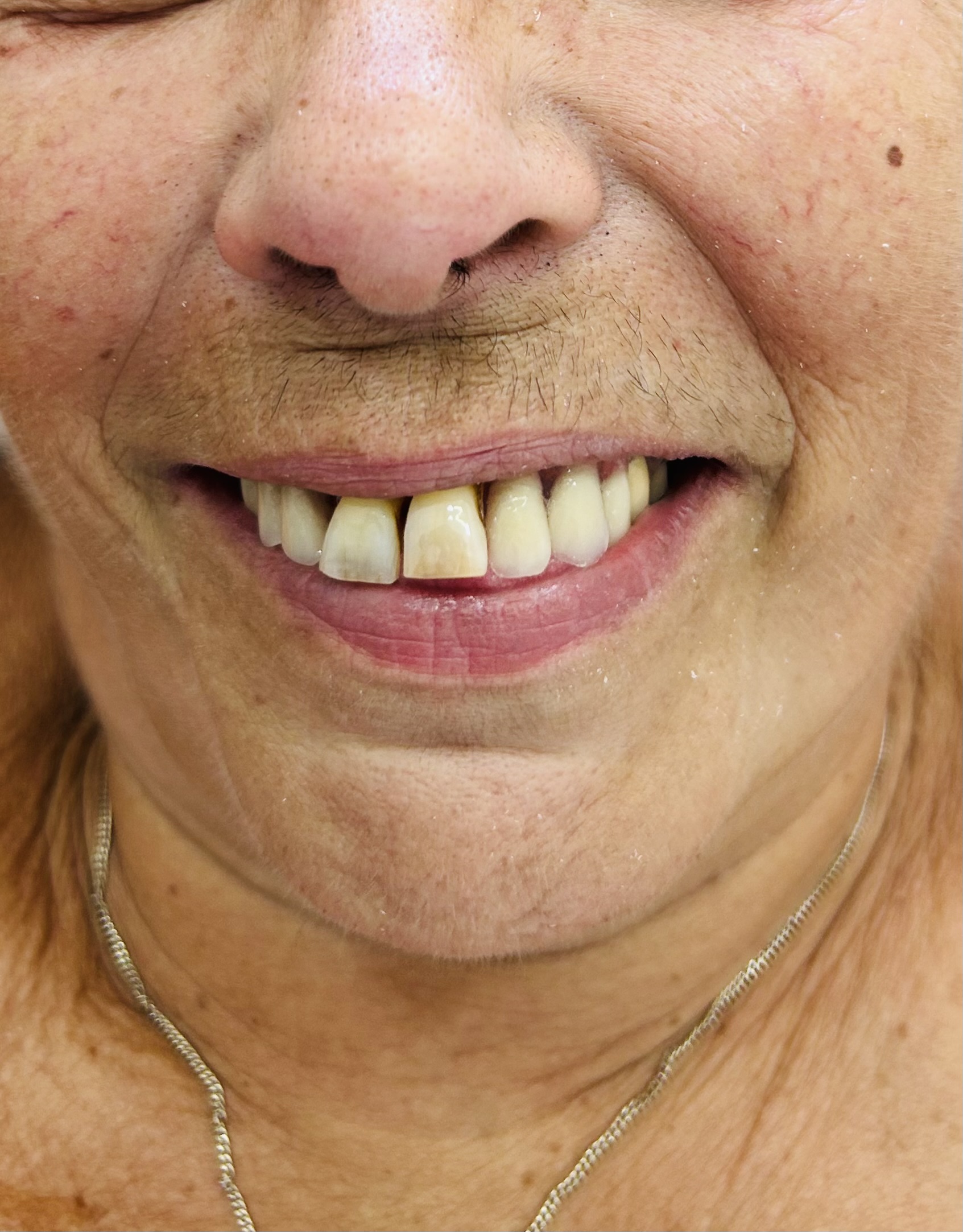 Denture — after treatment